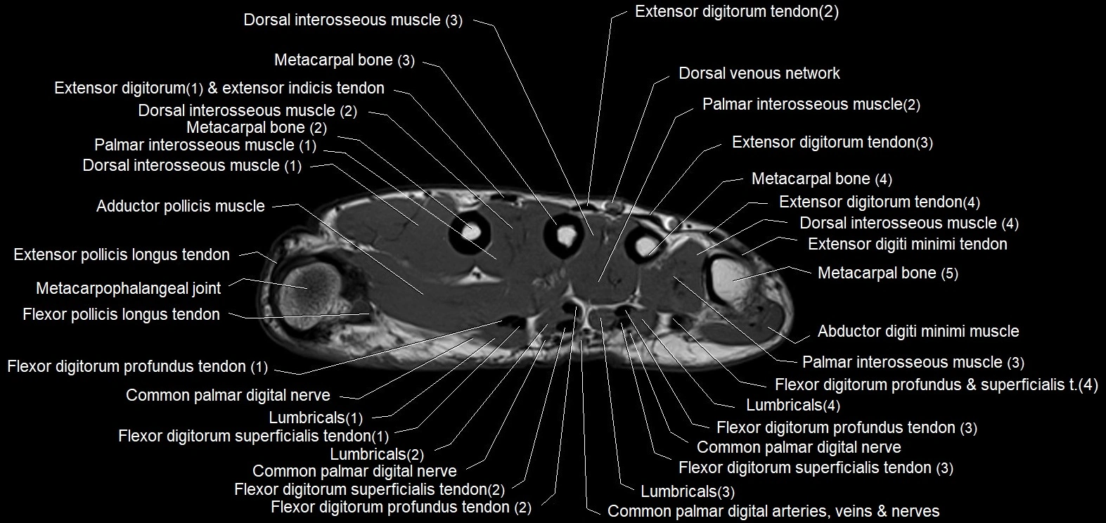 MRI 3T  hand axial labelled cross sectional anatomy imagemy  14.webp